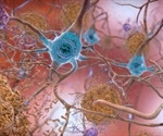 Researchers use cerebrospinal fluid to unlock pathways in Alzheimer's disease