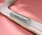 Hourglass-shaped stent shows promise for treating microvascular disease